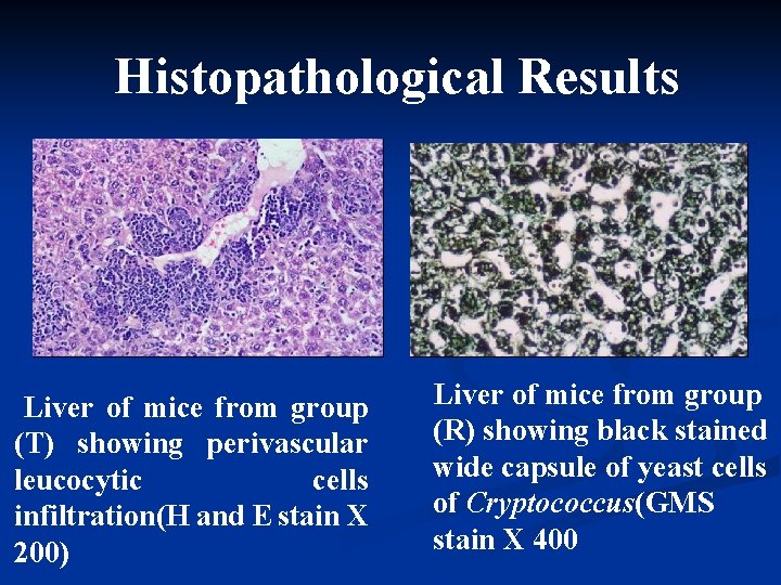 Histopathological Results Liver of mice from group (T) showing perivascular leucocytic cells infiltration(H and