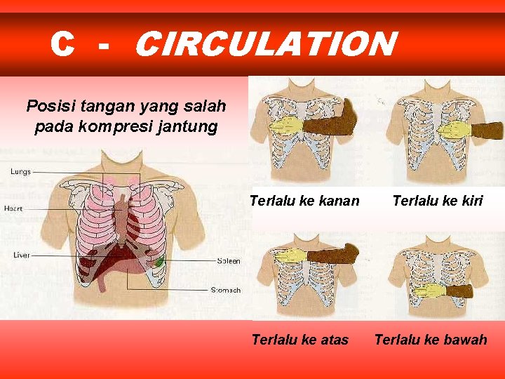 C - CIRCULATION Posisi tangan yang salah pada kompresi jantung Terlalu ke kanan Terlalu