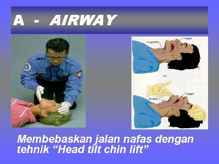 A - AIRWAY Membebaskan jalan nafas dengan tehnik “Head tilt chin lift” 