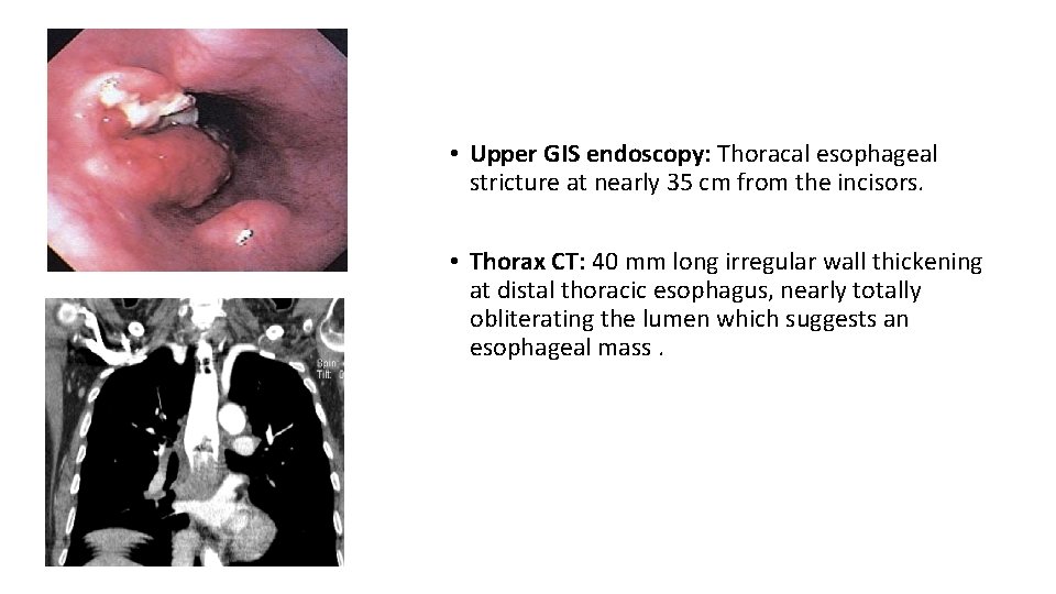  • Upper GIS endoscopy: Thoracal esophageal stricture at nearly 35 cm from the