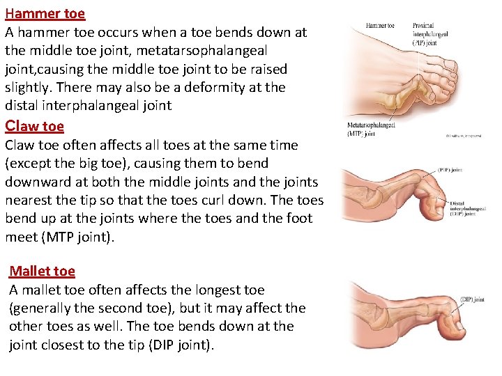 Hammer toe A hammer toe occurs when a toe bends down at the middle