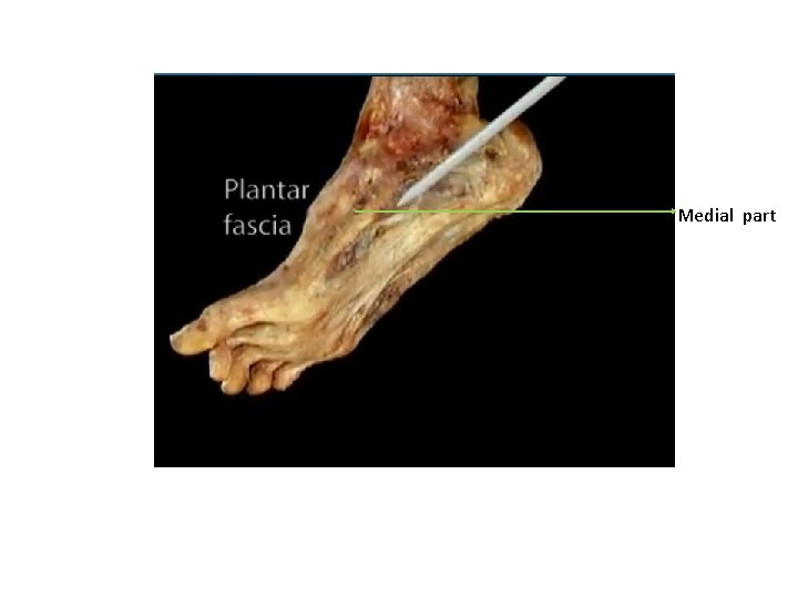 Medial part 