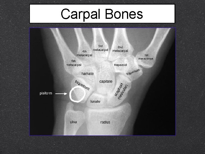 Carpal Bones 