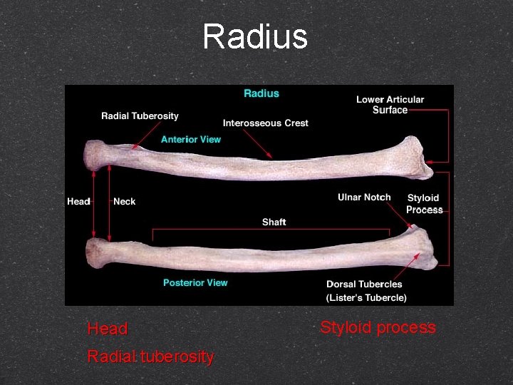 Radius Head Radial tuberosity Styloid process 