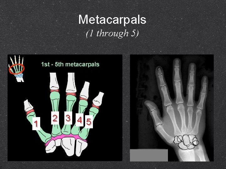 Metacarpals (1 through 5) 1 2 3 4 5 