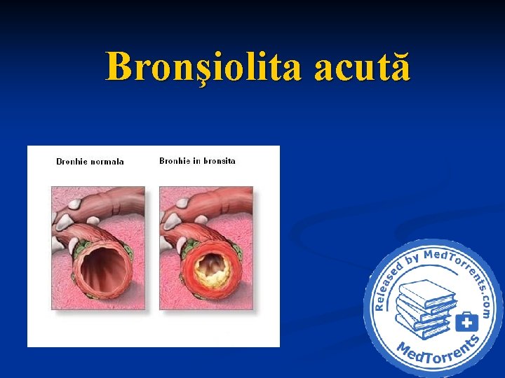 Bronşiolita acută 