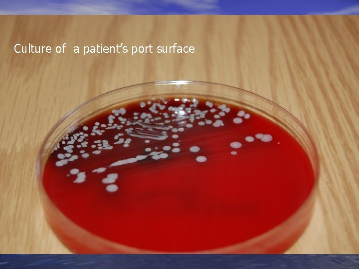Culture of a patient’s port surface Culture of a patient’s port surface