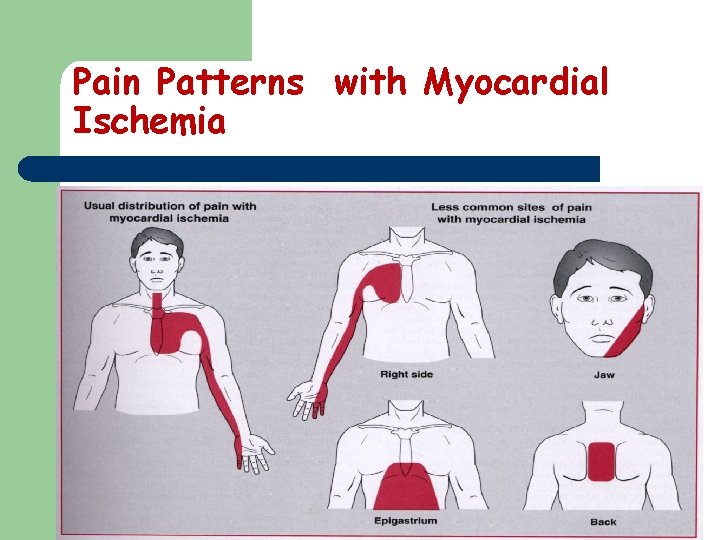Pain Patterns with Myocardial Ischemia 