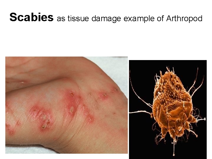 Scabies as tissue damage example of Arthropod Scabies as tissue damage example of Arthropod