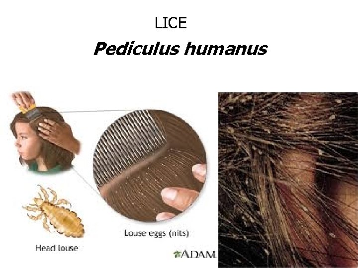 LICE Pediculus humanus LICE Pediculus humanus