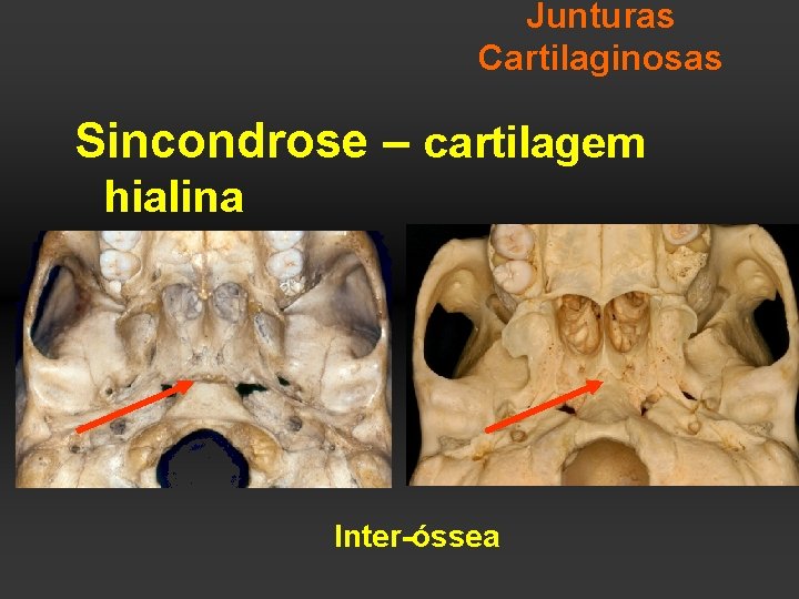 Junturas Cartilaginosas Sincondrose – cartilagem hialina Inter-óssea 