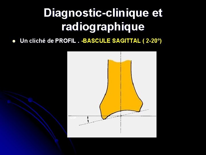 Diagnostic-clinique et radiographique l Un cliché de PROFIL. -BASCULE SAGITTAL ( 2 -20°) LGP