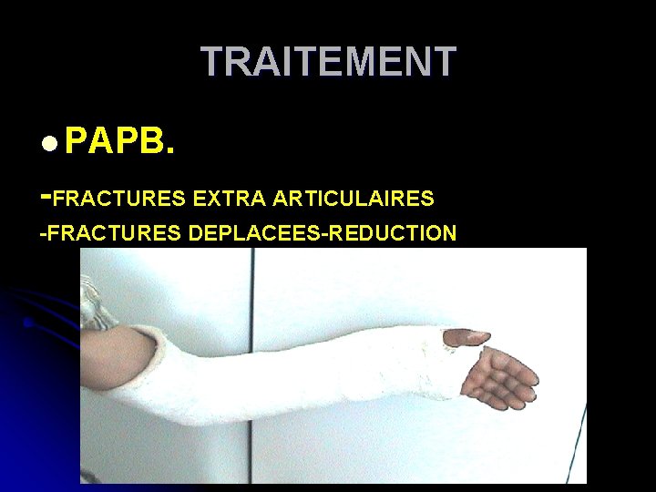 TRAITEMENT l PAPB. -FRACTURES EXTRA ARTICULAIRES -FRACTURES DEPLACEES-REDUCTION 