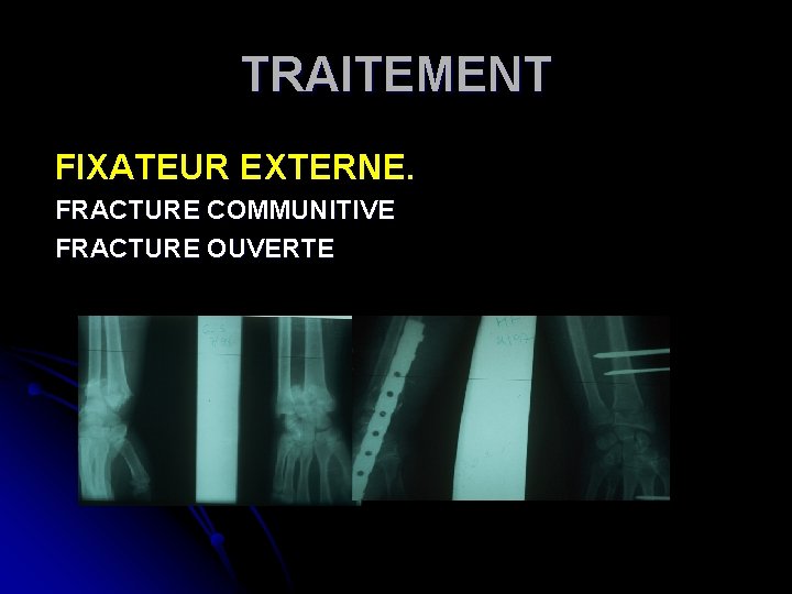 TRAITEMENT FIXATEUR EXTERNE. FRACTURE COMMUNITIVE FRACTURE OUVERTE 