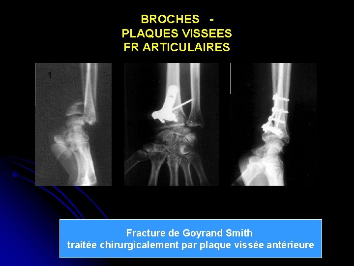 BROCHES PLAQUES VISSEES FR ARTICULAIRES 1 2 3 Fracture de Goyrand Smith traitée chirurgicalement