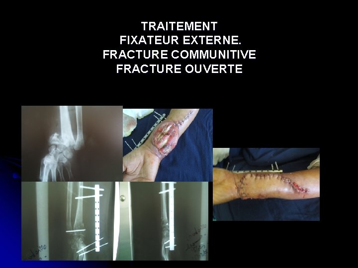 TRAITEMENT FIXATEUR EXTERNE. FRACTURE COMMUNITIVE FRACTURE OUVERTE 