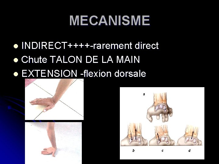 MECANISME INDIRECT++++-rarement direct l Chute TALON DE LA MAIN l EXTENSION -flexion dorsale l