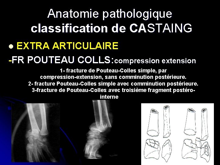 Anatomie pathologique classification de CASTAING EXTRA ARTICULAIRE -FR POUTEAU COLLS: compression extension l 1