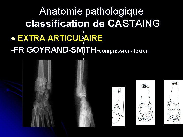 Anatomie pathologique classification de CASTAING c o m p r e s s i