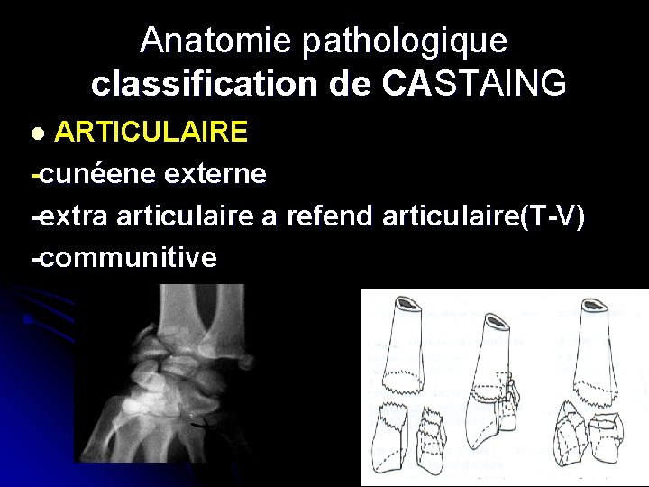 Anatomie pathologique classification de CASTAING ARTICULAIRE -cunéene externe -extra articulaire a refend articulaire(T-V) -communitive