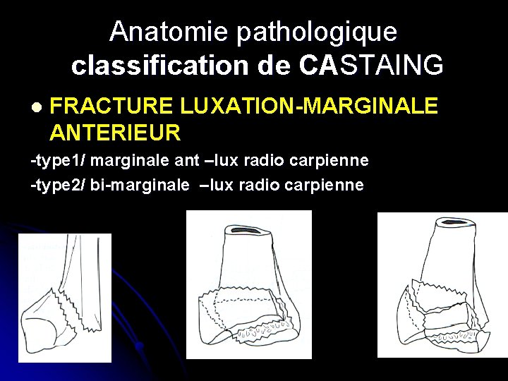 Anatomie pathologique classification de CASTAING l FRACTURE LUXATION-MARGINALE ANTERIEUR -type 1/ marginale ant –lux