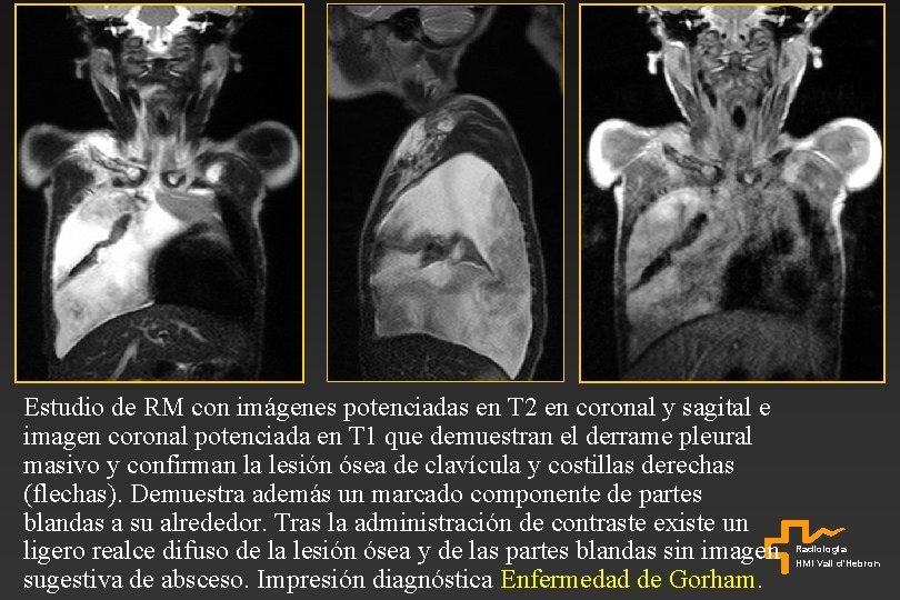 Estudio de RM con imágenes potenciadas en T 2 en coronal y sagital e