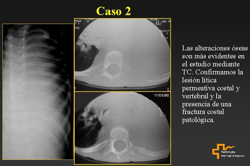 Caso 2 Las alteraciones óseas son más evidentes en el estudio mediante TC. Confirmamos