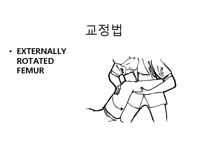 교정법 • EXTERNALLY ROTATED FEMUR 교정법 • EXTERNALLY ROTATED FEMUR
