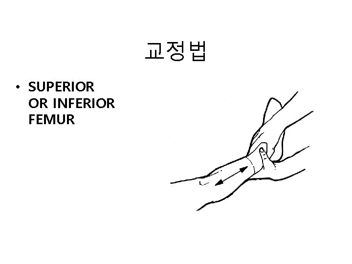 교정법 • SUPERIOR OR INFERIOR FEMUR 교정법 • SUPERIOR OR INFERIOR FEMUR