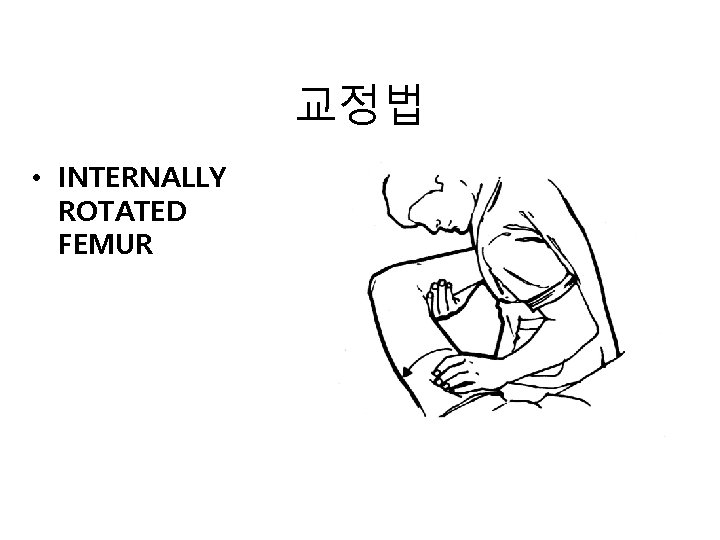 교정법 • INTERNALLY ROTATED FEMUR 교정법 • INTERNALLY ROTATED FEMUR
