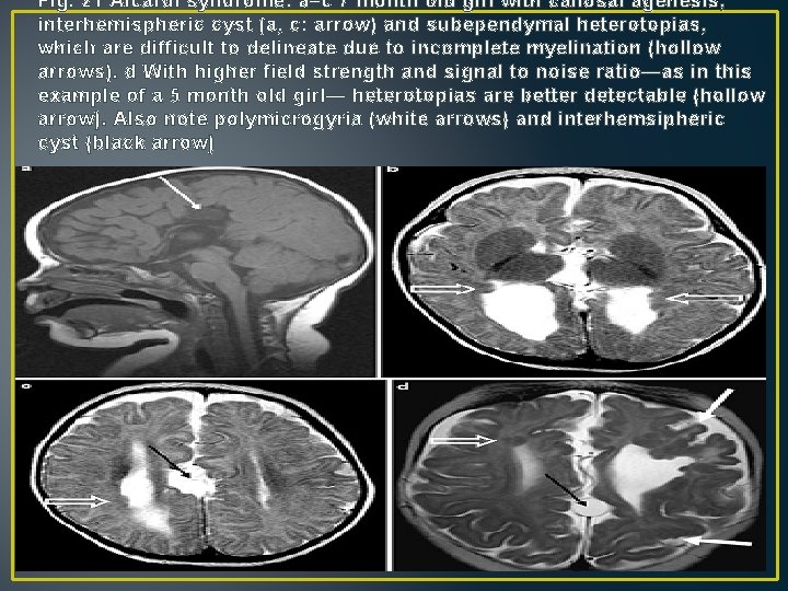 Fig. 21 Aicardi syndrome: a–c 7 month old girl with callosal agenesis, interhemispheric cyst Fig. 21 Aicardi syndrome: a–c 7 month old girl with callosal agenesis, interhemispheric cyst