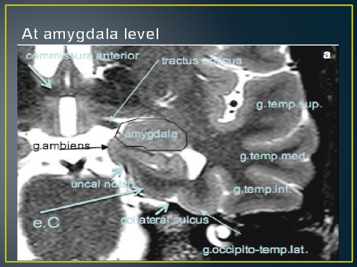 At amygdala level At amygdala level