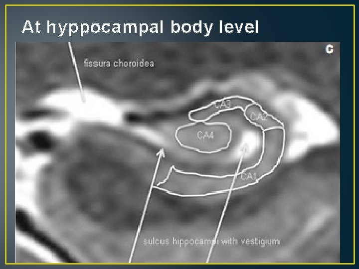 At hyppocampal body level At hyppocampal body level