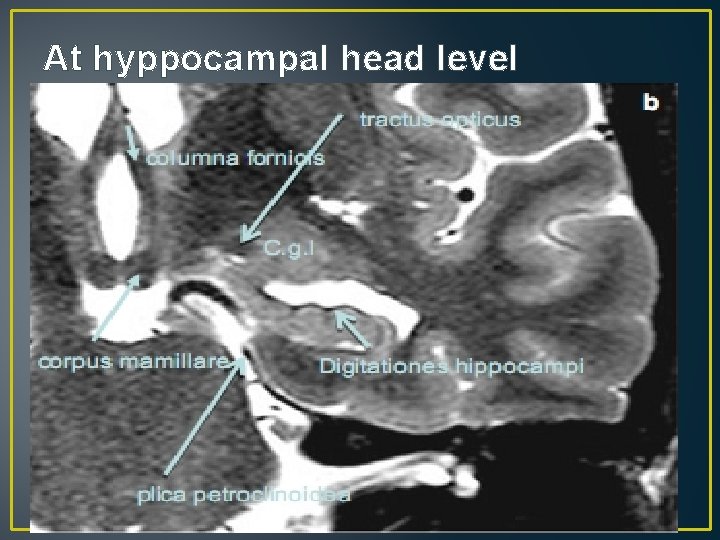 At hyppocampal head level At hyppocampal head level