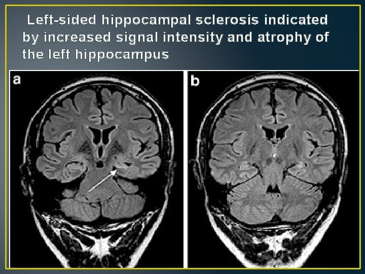 Left-sided hippocampal sclerosis indicated by increased signal intensity and atrophy of the left hippocampus Left-sided hippocampal sclerosis indicated by increased signal intensity and atrophy of the left hippocampus