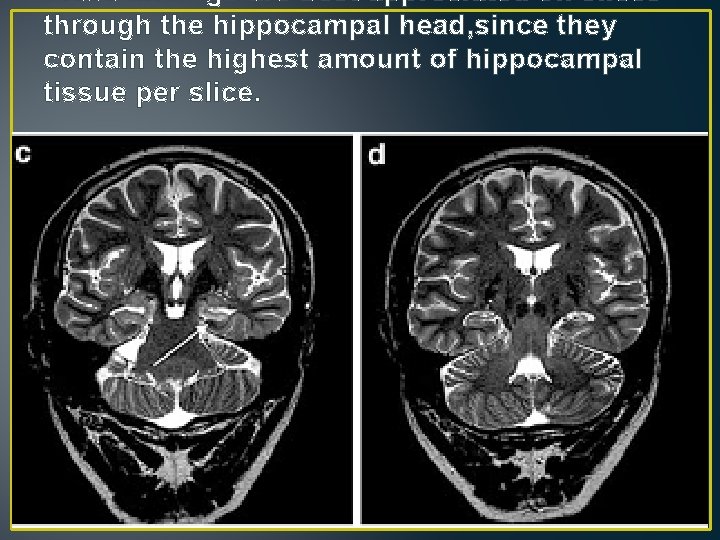 these findings are best appreciated on slices through the hippocampal head, since they contain these findings are best appreciated on slices through the hippocampal head, since they contain