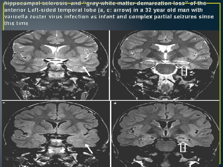 hippocampal sclerosis and ‘‘gray white matter demarcation loss’’ of the anterior Left-sided temporal lobe hippocampal sclerosis and ‘‘gray white matter demarcation loss’’ of the anterior Left-sided temporal lobe