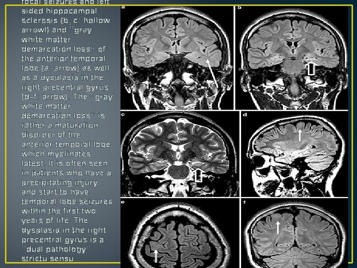 focal seizures and left sided hippocampal sclerosis (b, c: hollow arrowl) and ‘‘gray white focal seizures and left sided hippocampal sclerosis (b, c: hollow arrowl) and ‘‘gray white
