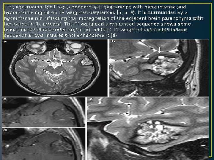 . The cavernoma itself has a popcorn-ball appearance with hyperintense and hypointense signal on . The cavernoma itself has a popcorn-ball appearance with hyperintense and hypointense signal on