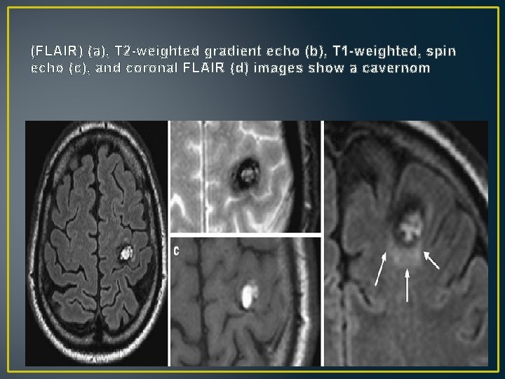 (FLAIR) (a), T 2 -weighted gradient echo (b), T 1 -weighted, spin echo (c), (FLAIR) (a), T 2 -weighted gradient echo (b), T 1 -weighted, spin echo (c),