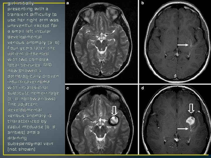 girl initially presenting with a transient difficulty to use her right arm was uneventful girl initially presenting with a transient difficulty to use her right arm was uneventful