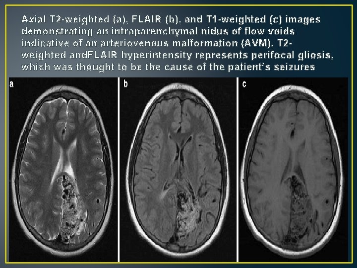 Axial T 2 -weighted (a), FLAIR (b), and T 1 -weighted (c) images demonstrating Axial T 2 -weighted (a), FLAIR (b), and T 1 -weighted (c) images demonstrating