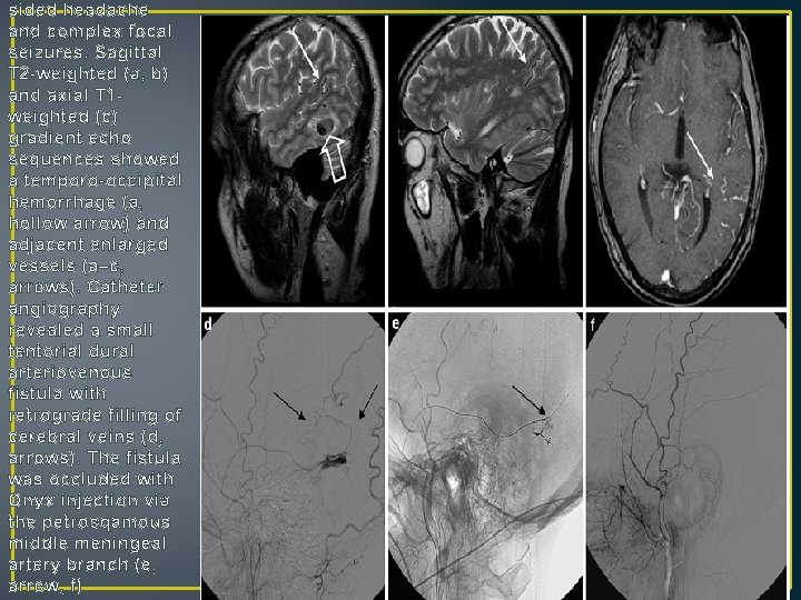 sided headache and complex focal seizures. Sagittal T 2 -weighted (a, b) and axial sided headache and complex focal seizures. Sagittal T 2 -weighted (a, b) and axial