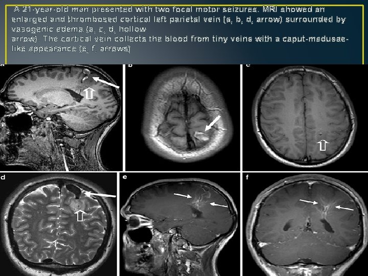 A 21 -year-old man presented with two focal motor seizures. MRI showed an enlarged A 21 -year-old man presented with two focal motor seizures. MRI showed an enlarged