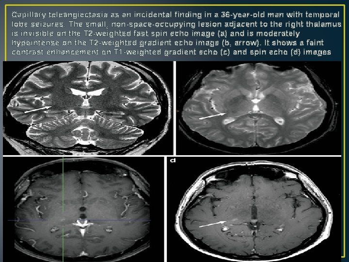 Capillary teleangiectasia as an incidental finding in a 36 -year-old man with temporal lobe Capillary teleangiectasia as an incidental finding in a 36 -year-old man with temporal lobe