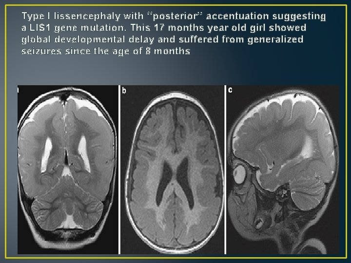 Type I lissencephaly with ‘‘posterior’’ accentuation suggesting a LIS 1 gene mutation. This 17 Type I lissencephaly with ‘‘posterior’’ accentuation suggesting a LIS 1 gene mutation. This 17