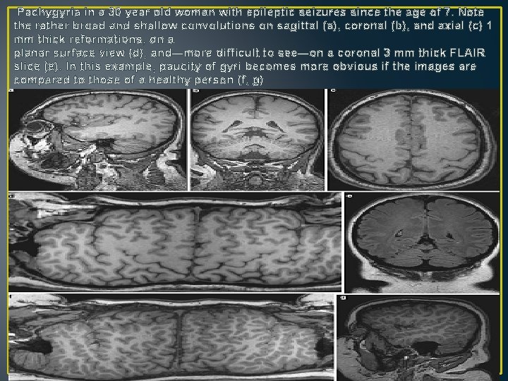 Pachygyria in a 30 year old woman with epileptic seizures since the age of Pachygyria in a 30 year old woman with epileptic seizures since the age of