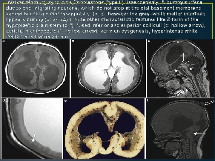 Walker-Warburg syndrome, Cobblestone (type II) lissencephaly, A bumpy surface due to overmigrating neurons, which Walker-Warburg syndrome, Cobblestone (type II) lissencephaly, A bumpy surface due to overmigrating neurons, which