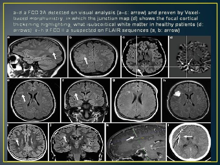 a–d a FCD 2 A detected on visual analysis (a–c: arrow) and proven by a–d a FCD 2 A detected on visual analysis (a–c: arrow) and proven by