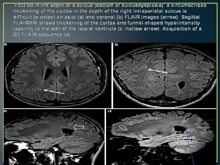 FCD 2 B in the depth of a sulcus (bottom of sulcusdysplasia): a circumscribed FCD 2 B in the depth of a sulcus (bottom of sulcusdysplasia): a circumscribed